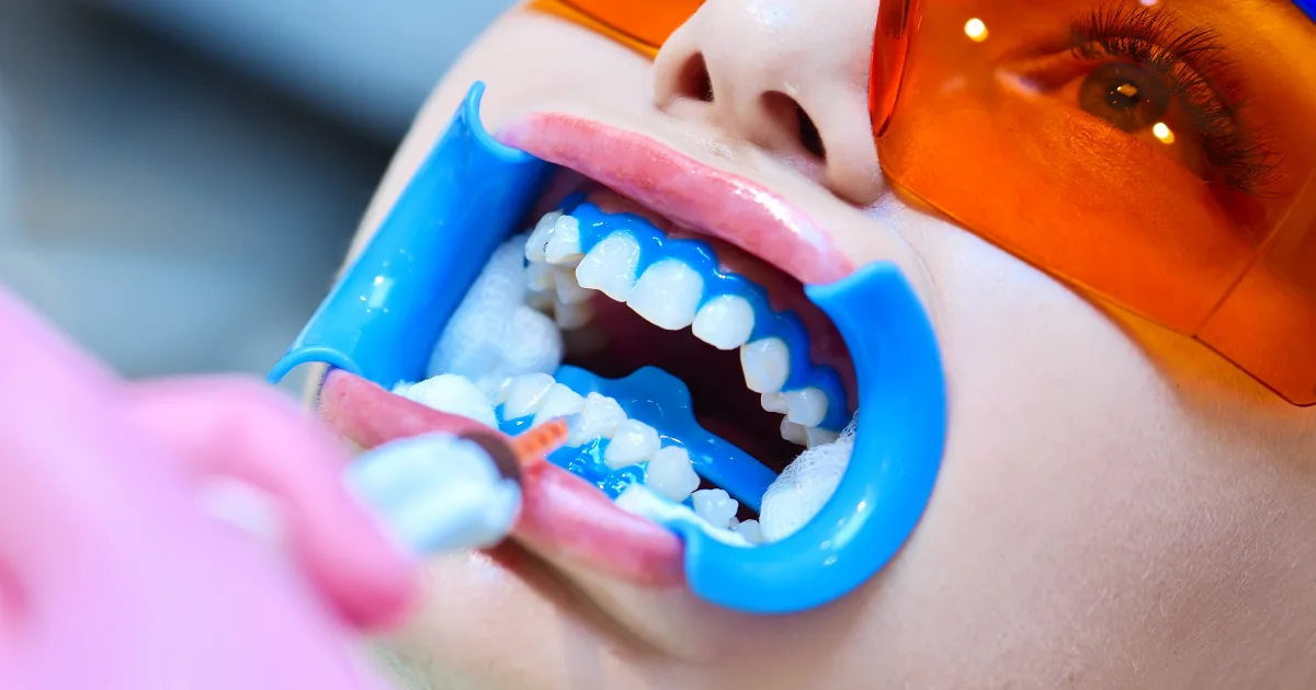 Clareamento dental - Dra. Jaqueline Sayonara em Sapé/PB