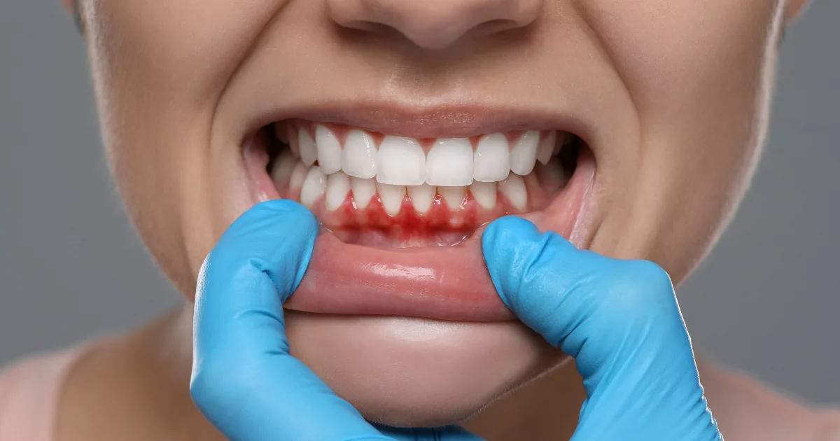 Cuidados com a gengiva e limpeza dental - Dra. Jaqueline Sayonara em Sapé/PB