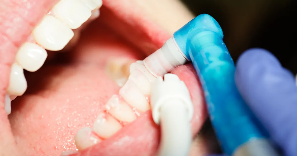 Limpeza dental (profilaxia) - Dra. Jaqueline Sayonara em Sapé/PB