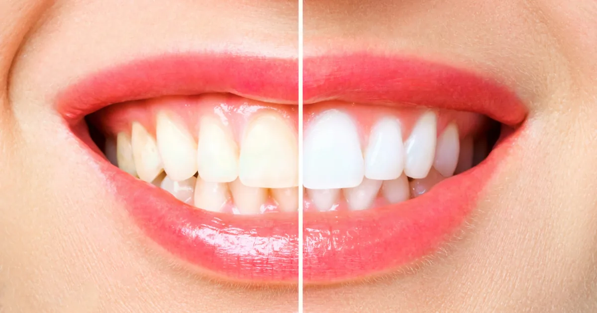 Procedimento de clareamento dental