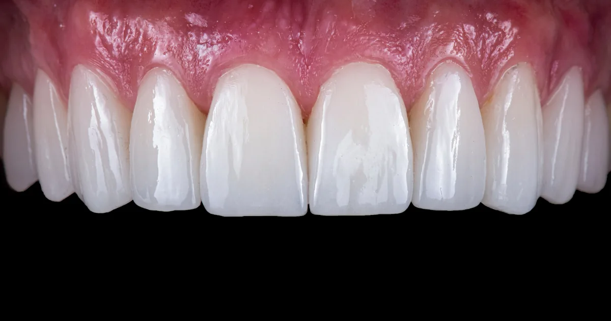Facetas dentárias em resina