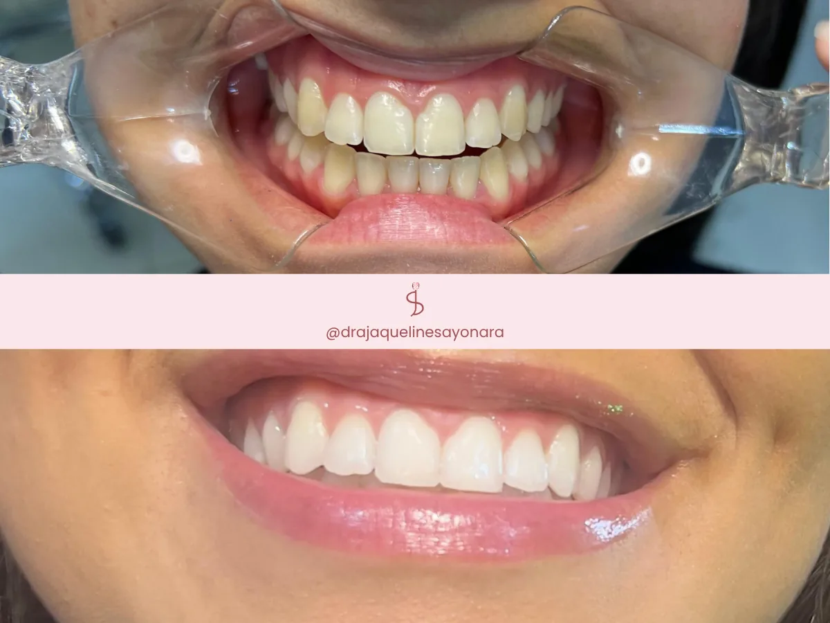 Antes e depois de clareamento dental