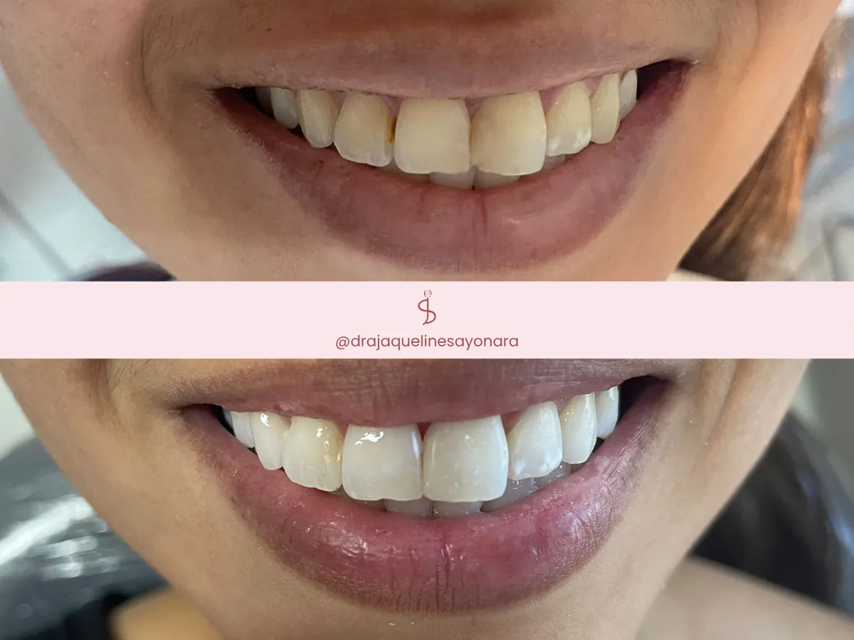 Antes e depois de clareamento dental