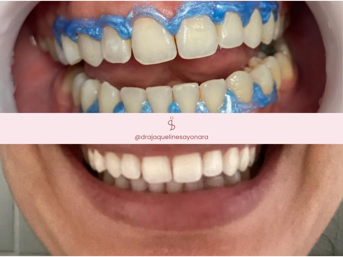 Antes e depois de clareamento dental