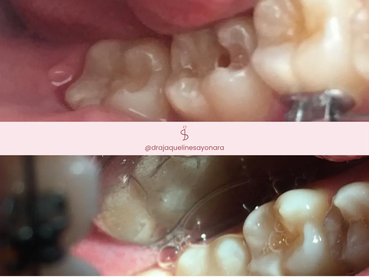 Antes e depois de facetas dentárias