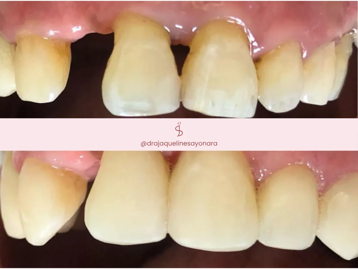 Antes e depois de facetas dentárias