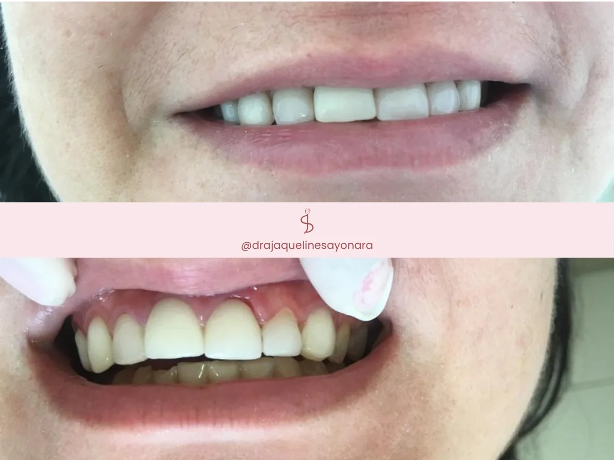 Antes e depois de facetas dentárias