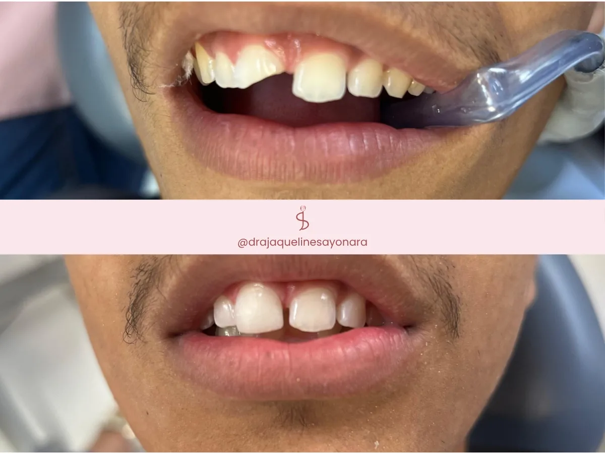 Antes e depois de facetas dentárias