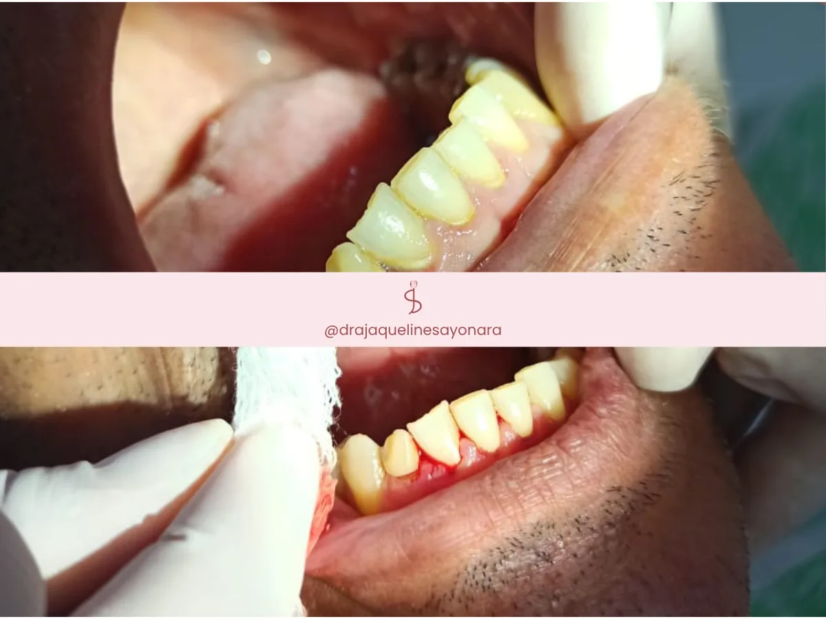 Antes e depois de limpeza dental