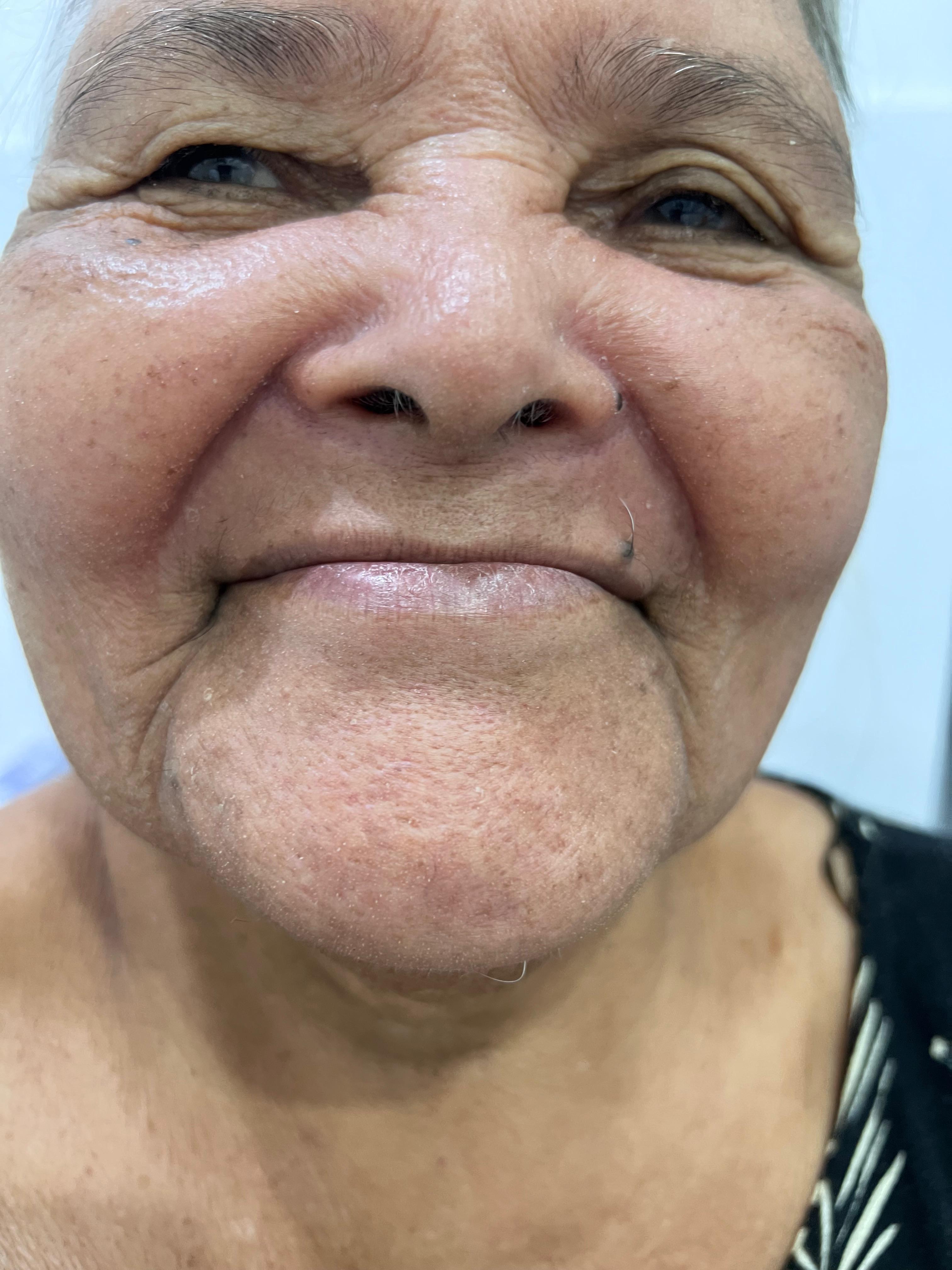 Antes do tratamento com prótese dentária