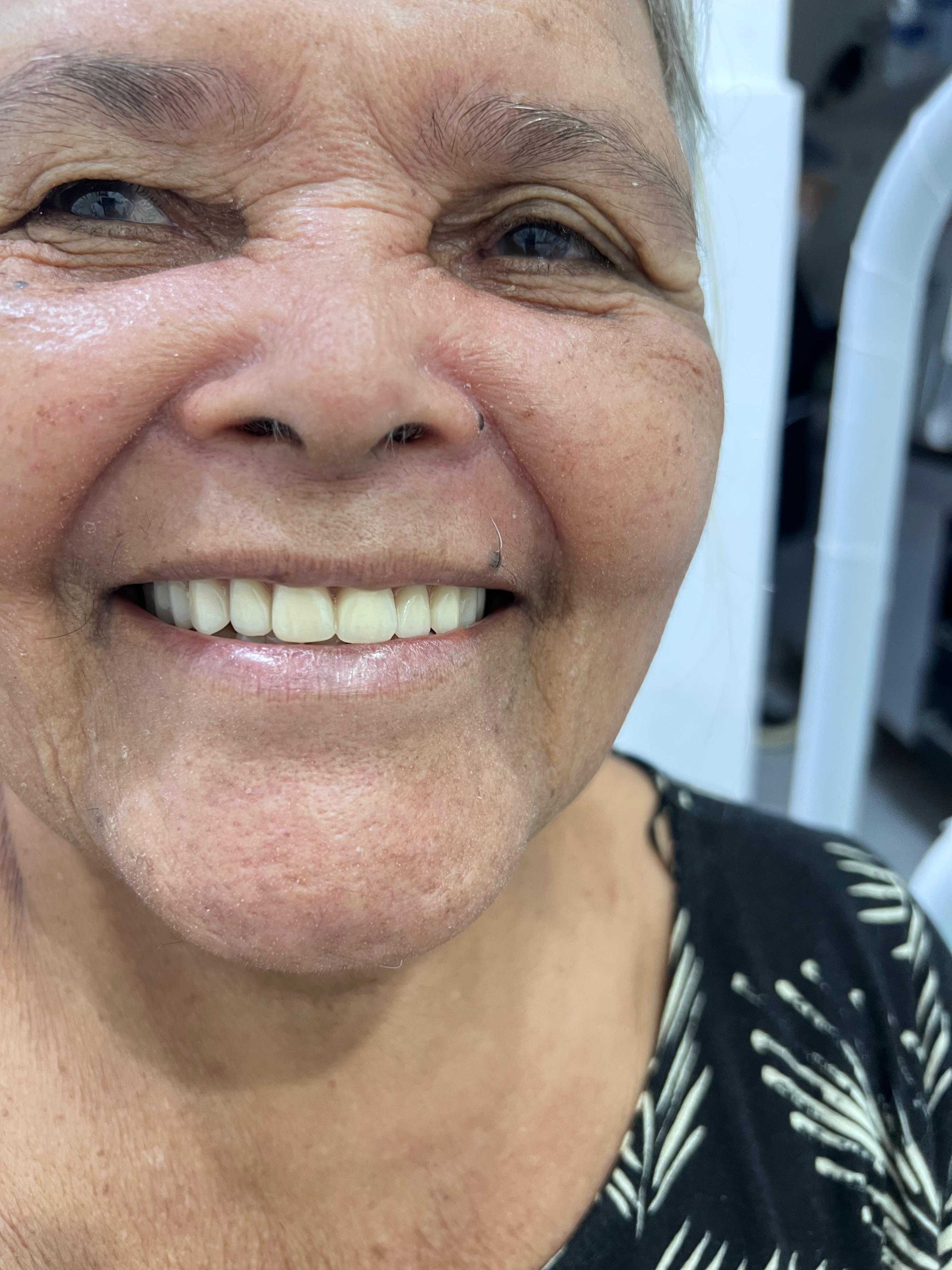 Depois do tratamento com prótese dentária