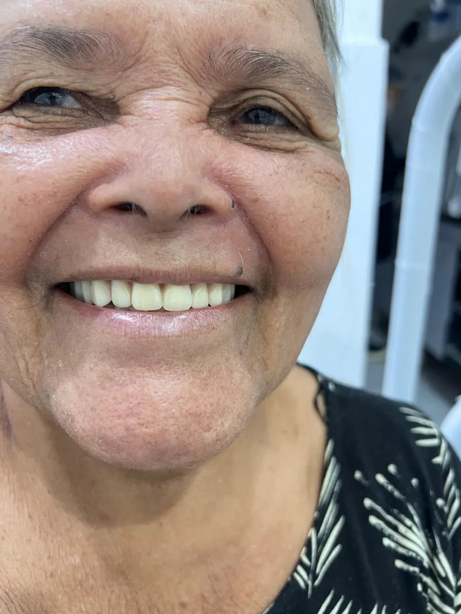 Depois do tratamento com prótese dentária