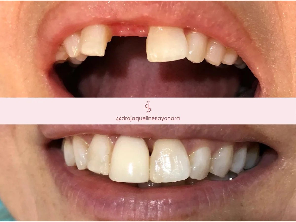 Antes e depois de prótese dentária