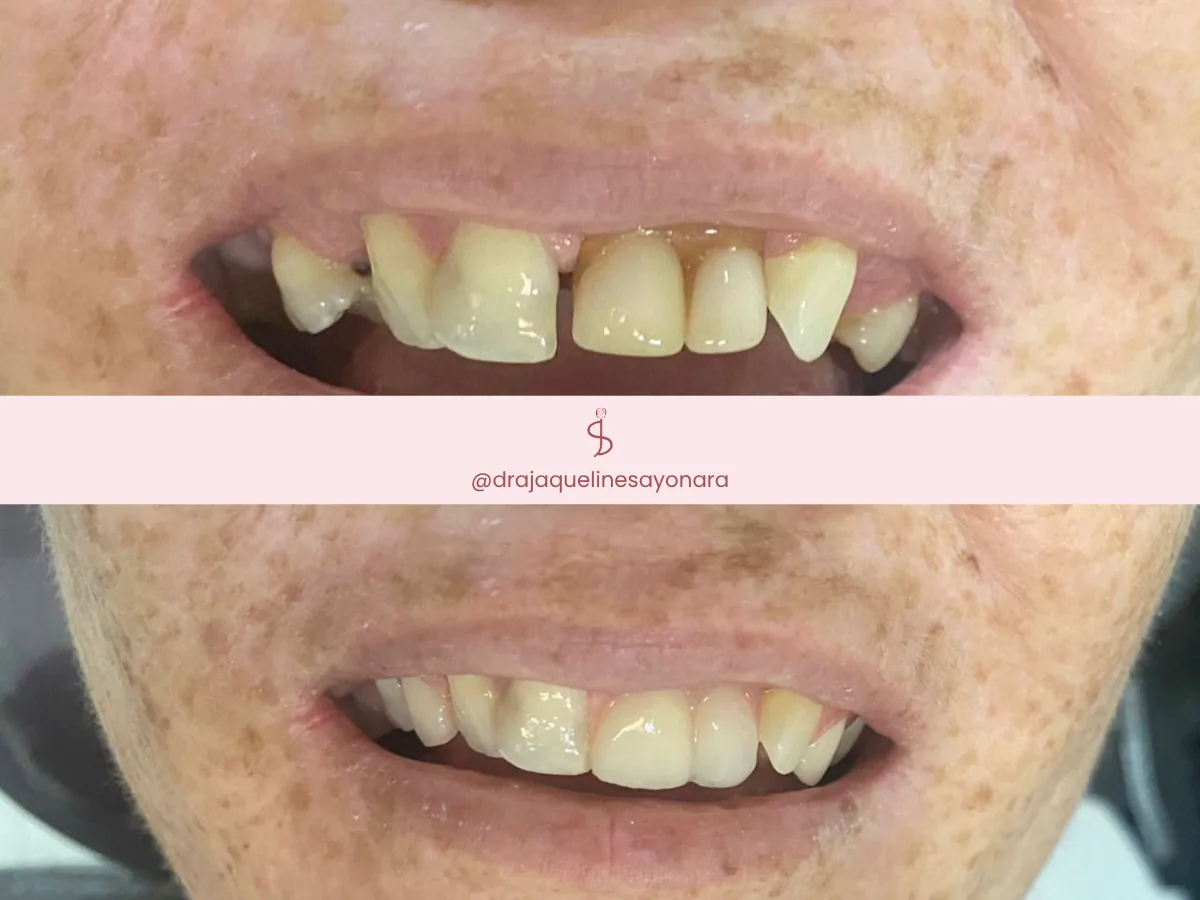Antes e depois de restauração dentária